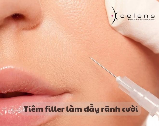 Tiêm filler làm đầy rãnh cười