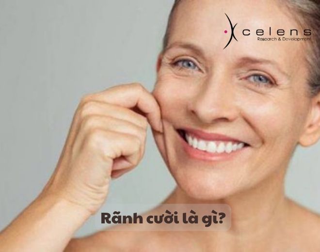 Làm đầy rãnh cười là gì?